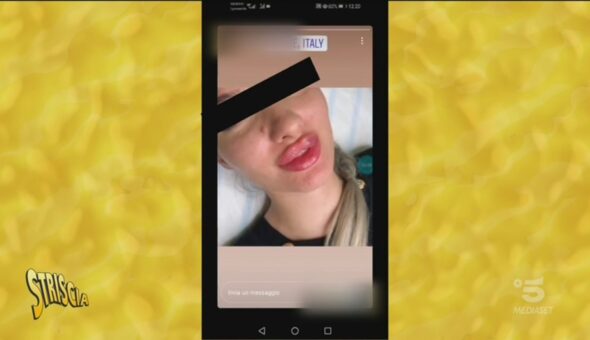 Russian Lips, il filler senza sicurezza